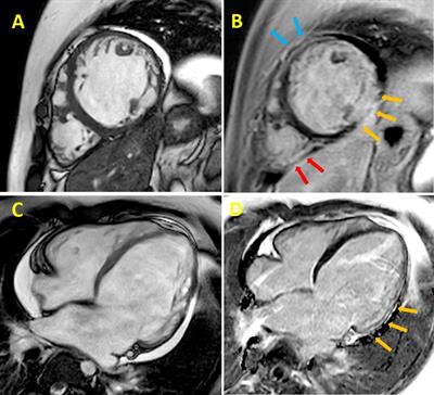 Advances in Stem Cell Modeling of Dystrophin-Associated Disease: Implications for the Wider World of Dilated Cardiomyopathy